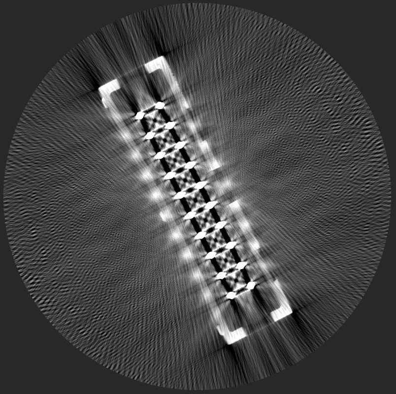 金属アーチファクト